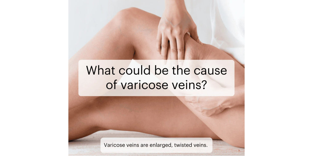 Varicose veins: Causes and solutions
